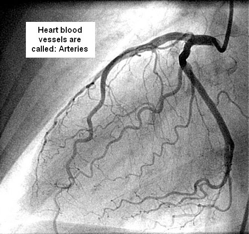 angiogram