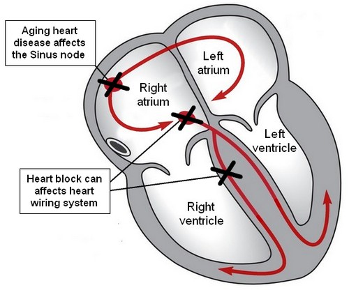 sick sinus syndrome and pacemaker