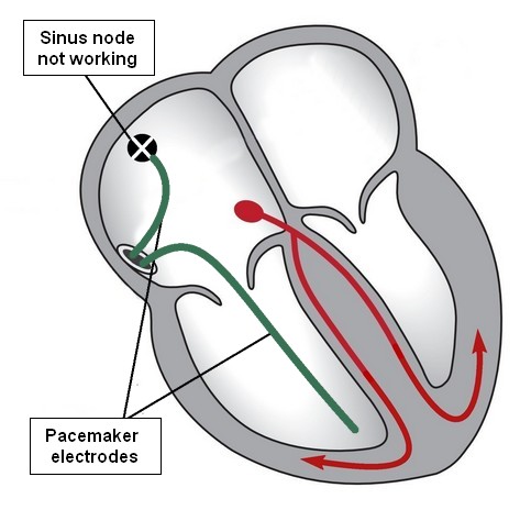 Chamber heart single Implantable cardioverter