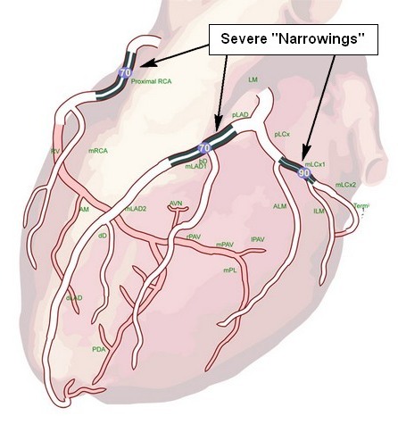 how angiography is done