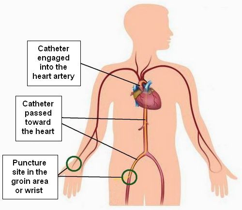 how angiography is done