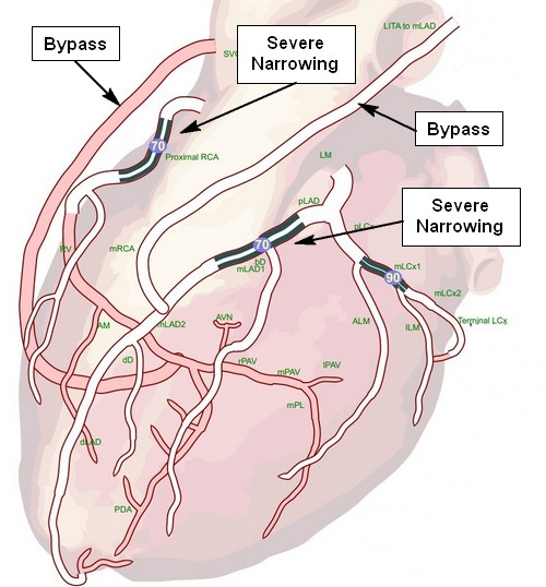 cabg_anot_500