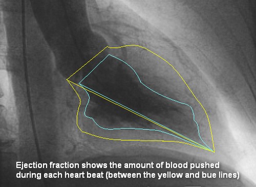 LV_ejection_fraction_500